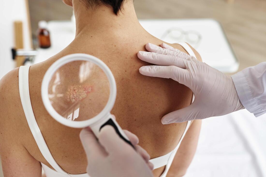 Challenging the Stigma Associated with Psoriasis Image 3