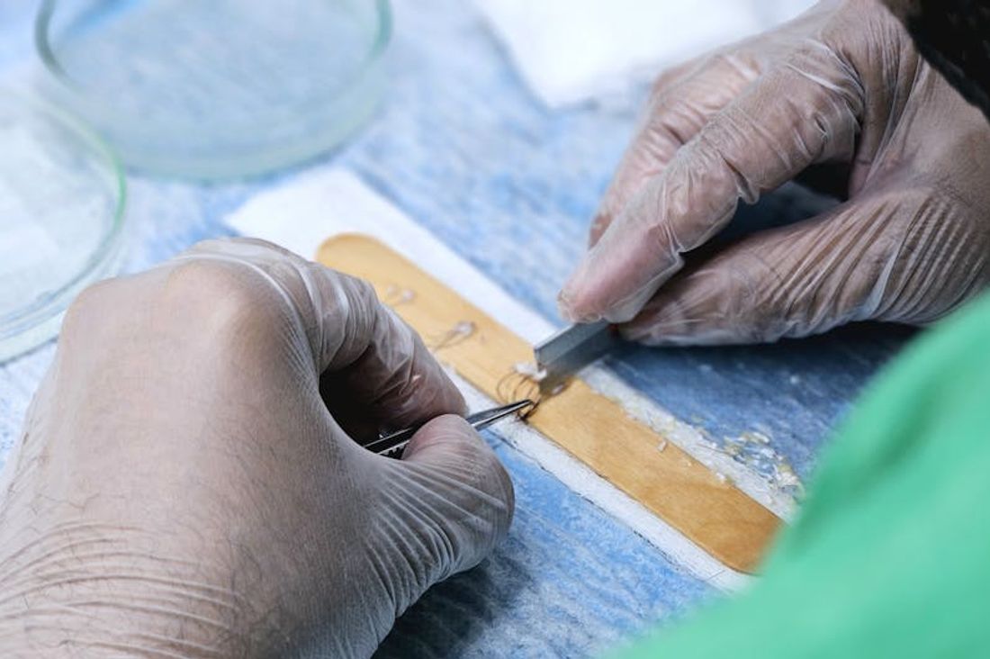 What is a Hair Transplant?