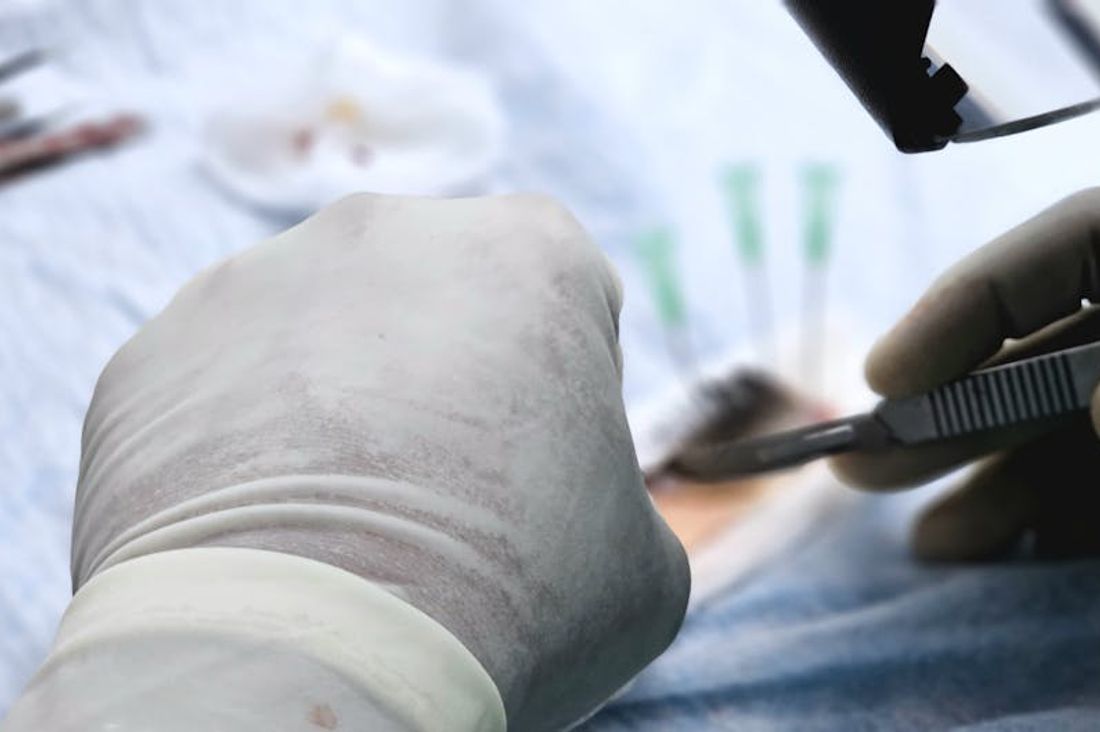 Types of Hair Transplant Methods