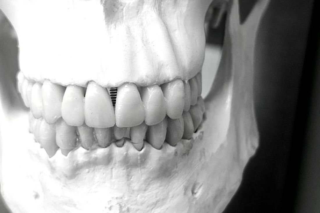 The Dental Implant Procedure: Step by Step
