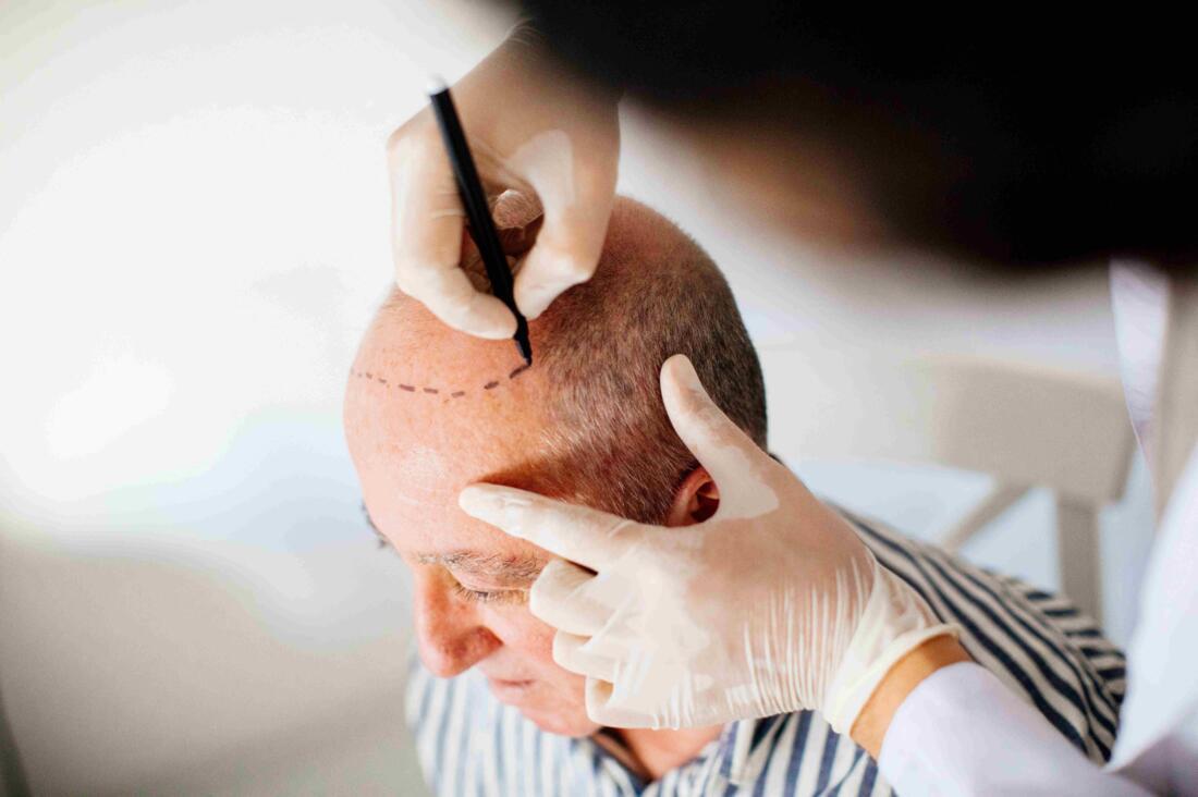 New Developments in Hair Transplantation: Addressing Hair Loss Image 2